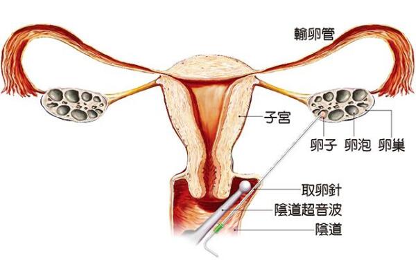 早产儿