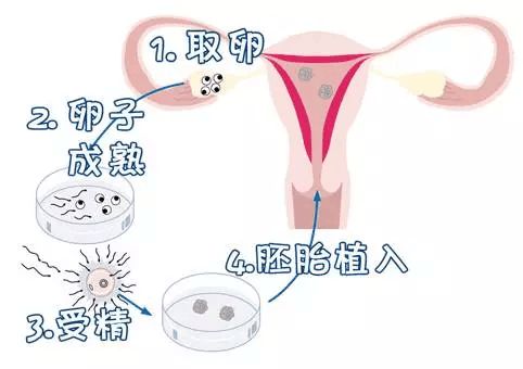 泰国试管婴儿供卵