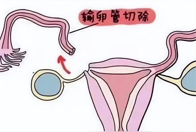 泰国试管婴儿