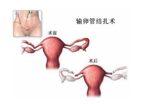 泰国试管婴儿技