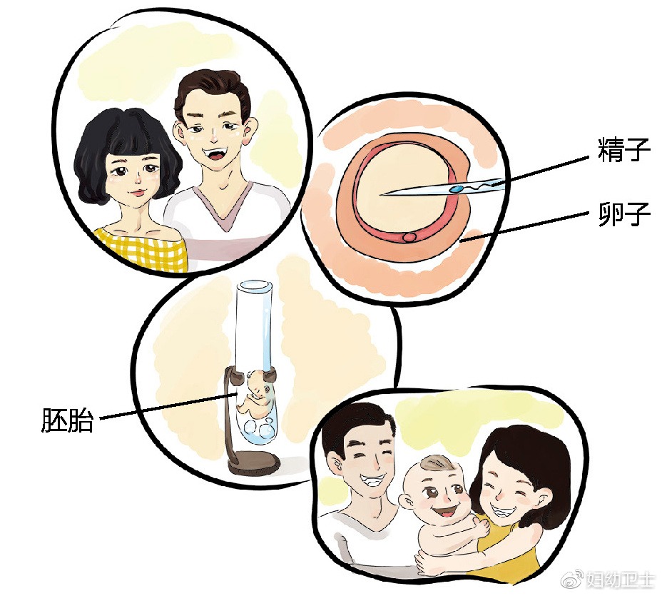 试管婴儿